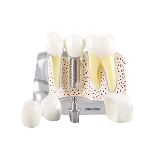 שיניים הפגנת דגם שתל נשלף ניתוח כתר גשר לרופא למטופל תקשורת והוראה שיניים דגם